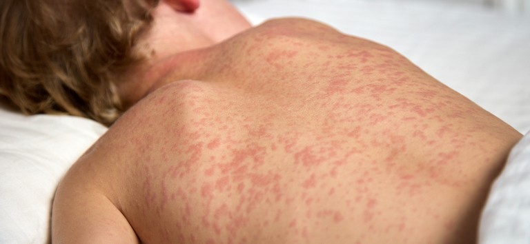 Casos de sarampo em São Paulo sobem para 26 após três novas confirmações na capital - QTU Questões do Universo